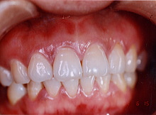 歯周病症例集１治療後写真