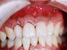 歯周病症例集１治療前写真