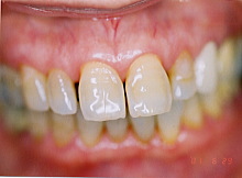歯周病症例集３治療後写真