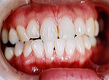 歯周病症例集４治療後写真