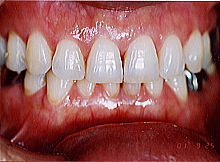 歯周病症例集５治療後写真